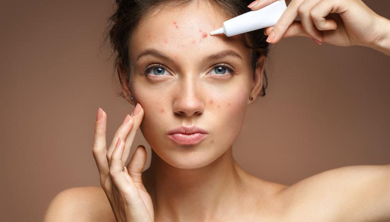 A Health and Beauty Shoot Needs Models With Acne + 2 More Gigs